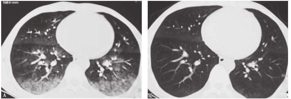 图4 系统性红斑狼疮伴弥漫性肺泡出血胸部CT表现.jpg